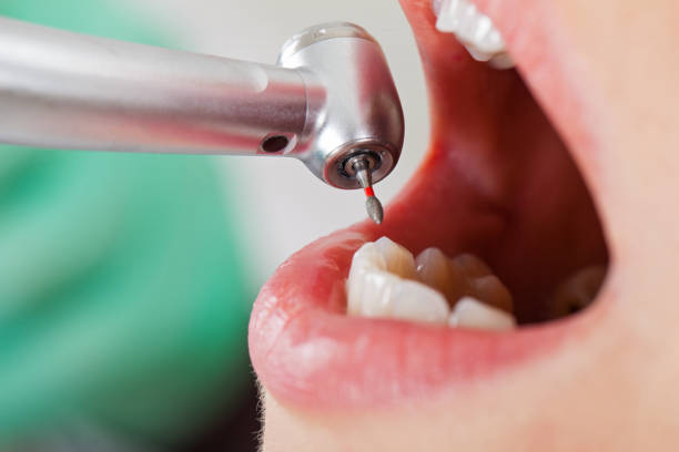 Best Emergency Dentist for Knocked-Out Tooth in Wailea, HI